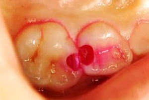 「う蝕検知液」で虫歯の取り残し・削りすぎを防ぐ